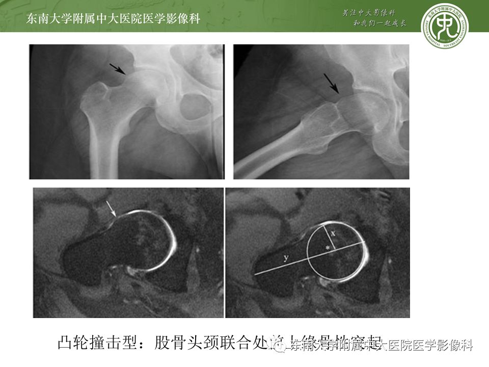 【病例】髋关节撞击综合征1例MR
