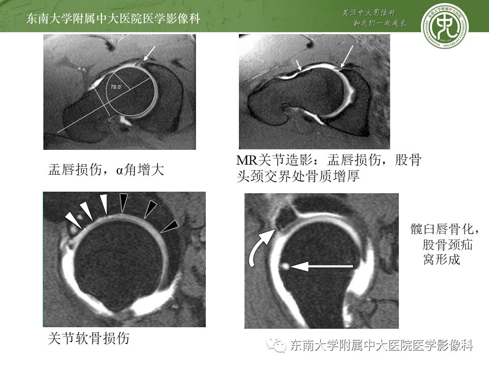 【病例】髋关节撞击综合征1例MR