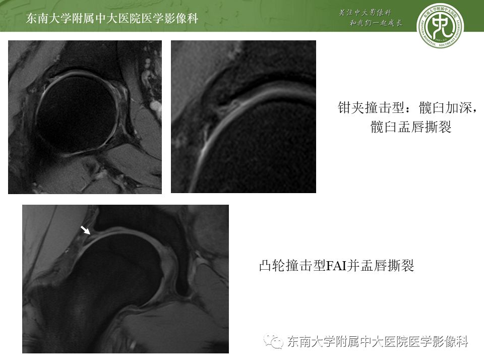 【病例】髋关节撞击综合征1例MR