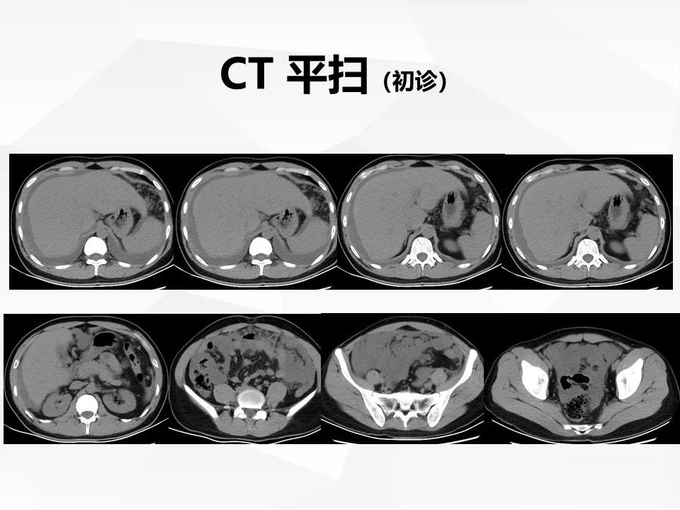 【病例】腹腔多发炎性肌纤维母细胞瘤IMT1例