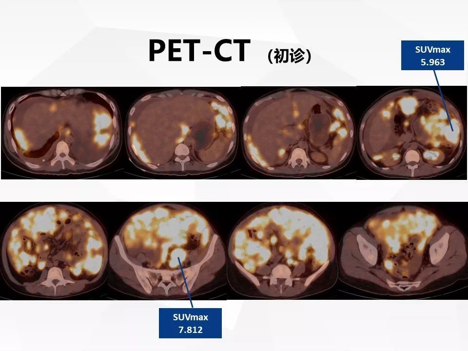 【病例】腹腔多发炎性肌纤维母细胞瘤IMT1例