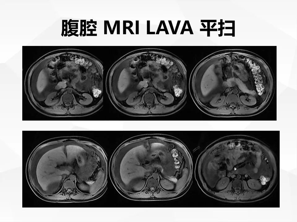 【病例】腹腔多发炎性肌纤维母细胞瘤IMT1例