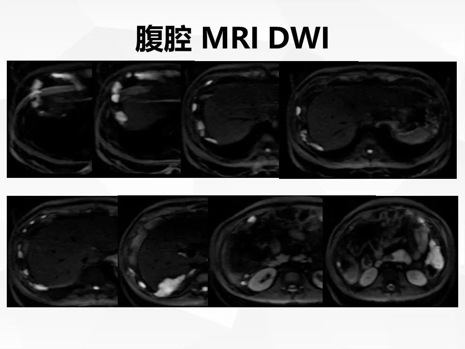 【病例】腹腔多发炎性肌纤维母细胞瘤IMT1例