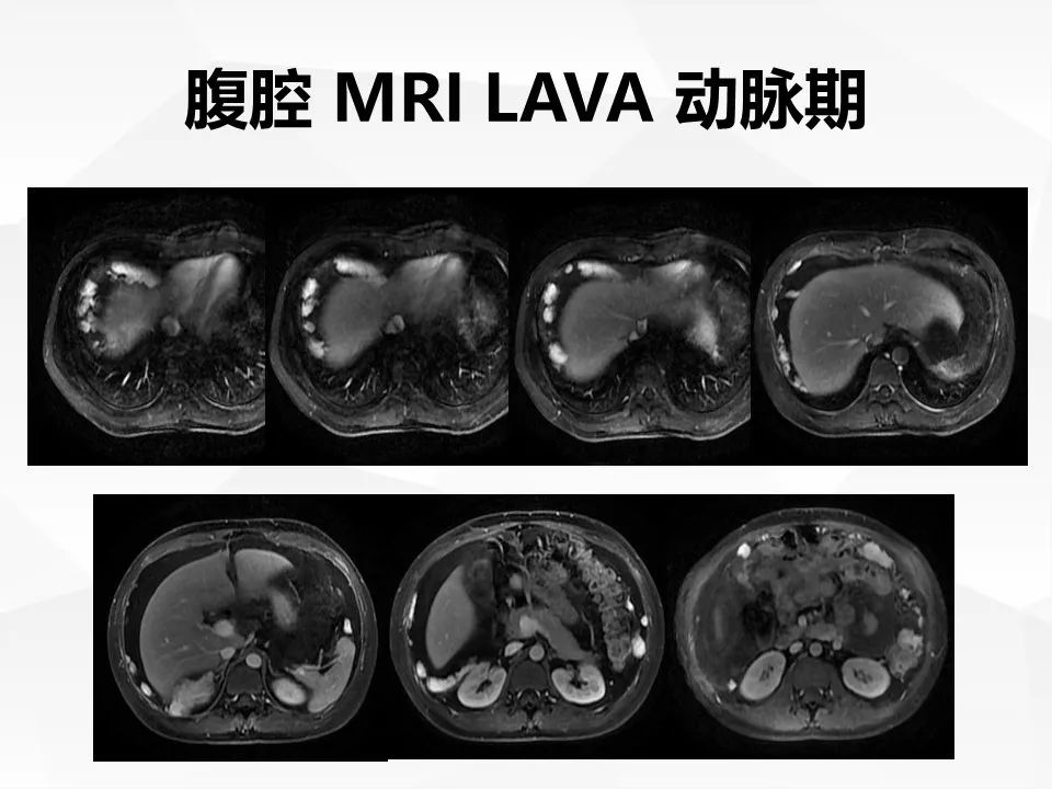 【病例】腹腔多发炎性肌纤维母细胞瘤IMT1例