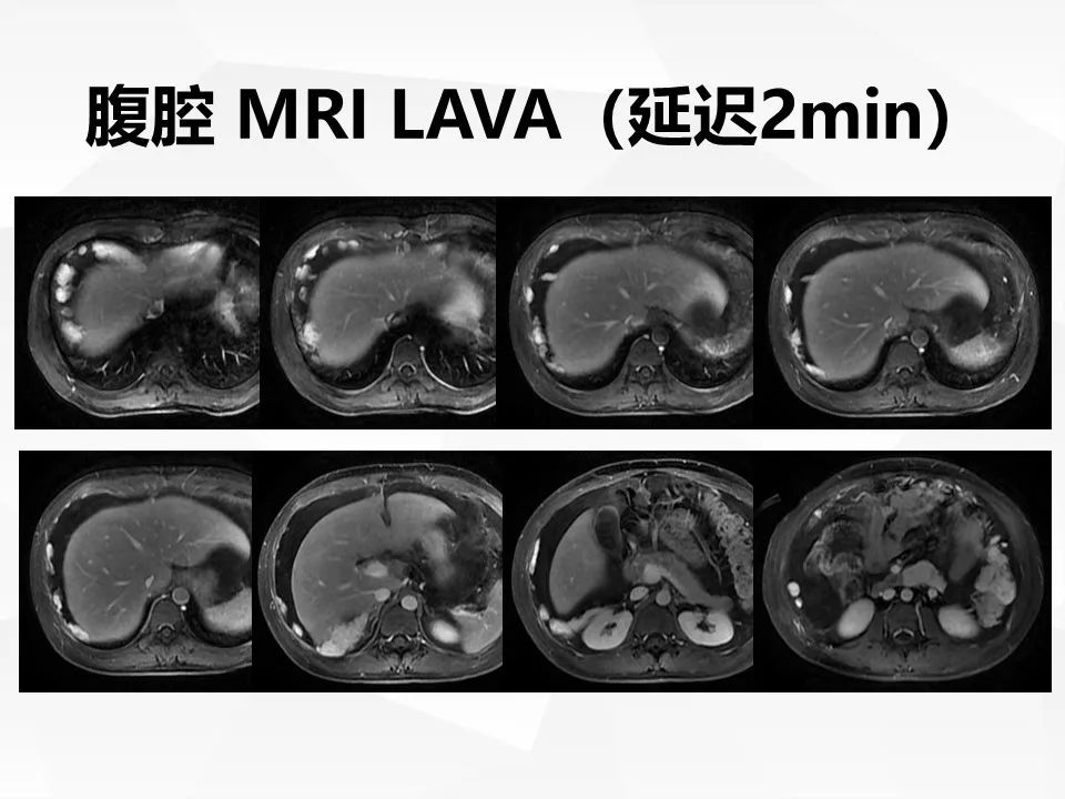 【病例】腹腔多发炎性肌纤维母细胞瘤IMT1例