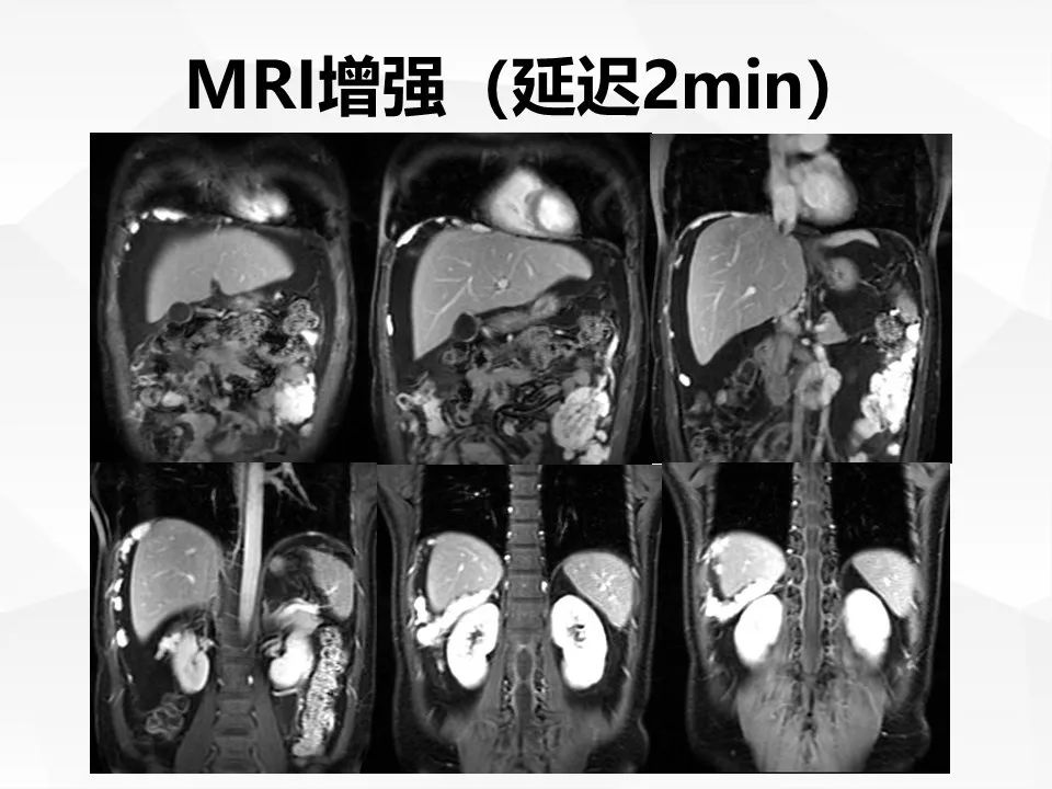 【病例】腹腔多发炎性肌纤维母细胞瘤IMT1例
