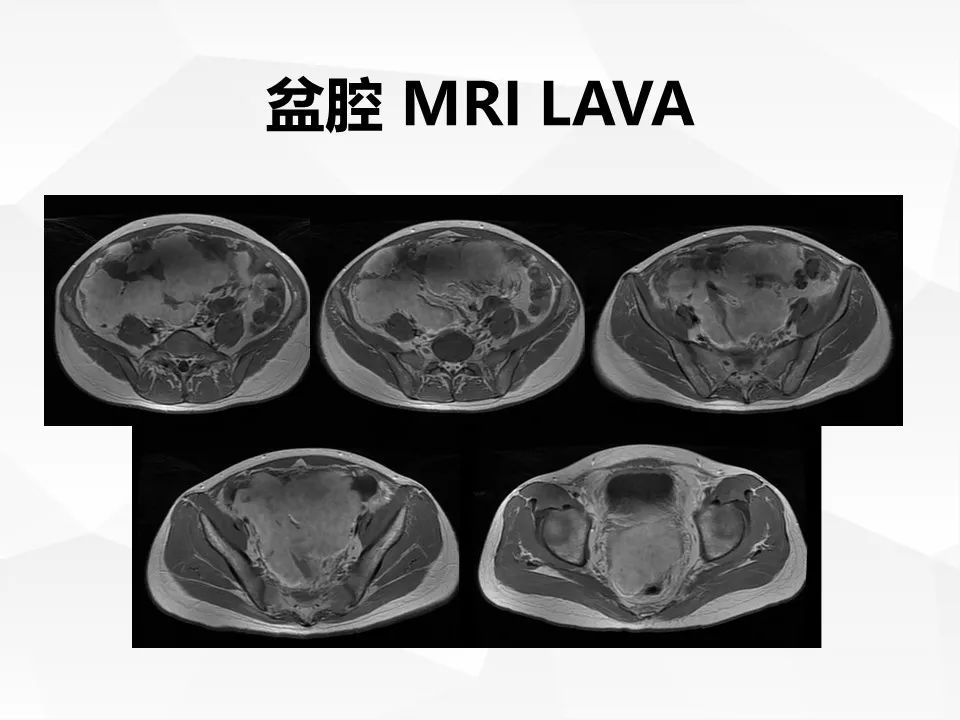 【病例】腹腔多发炎性肌纤维母细胞瘤IMT1例
