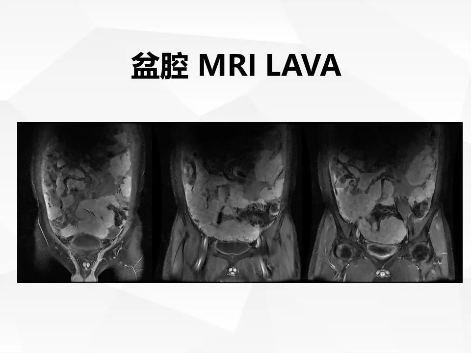 【病例】腹腔多发炎性肌纤维母细胞瘤IMT1例