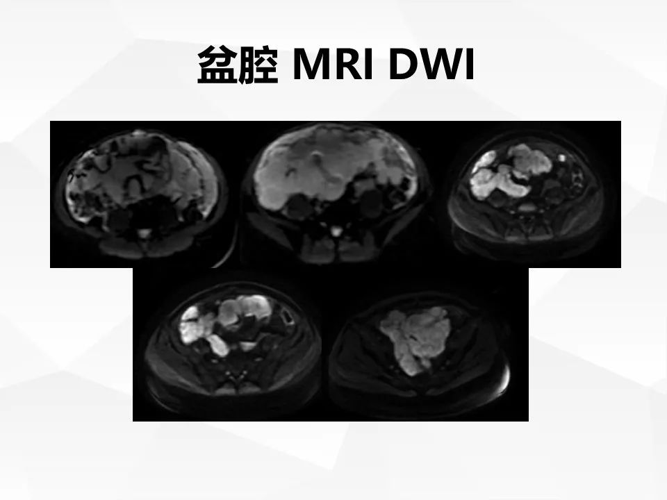 【病例】腹腔多发炎性肌纤维母细胞瘤IMT1例