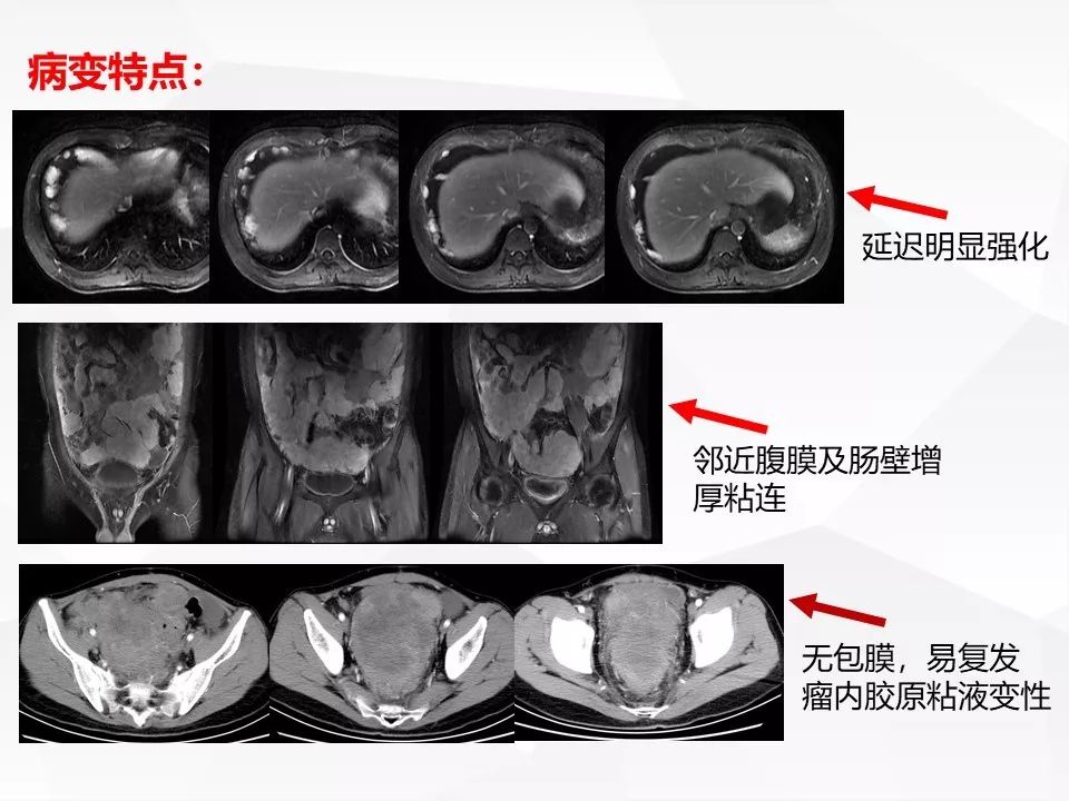 【病例】腹腔多发炎性肌纤维母细胞瘤IMT1例