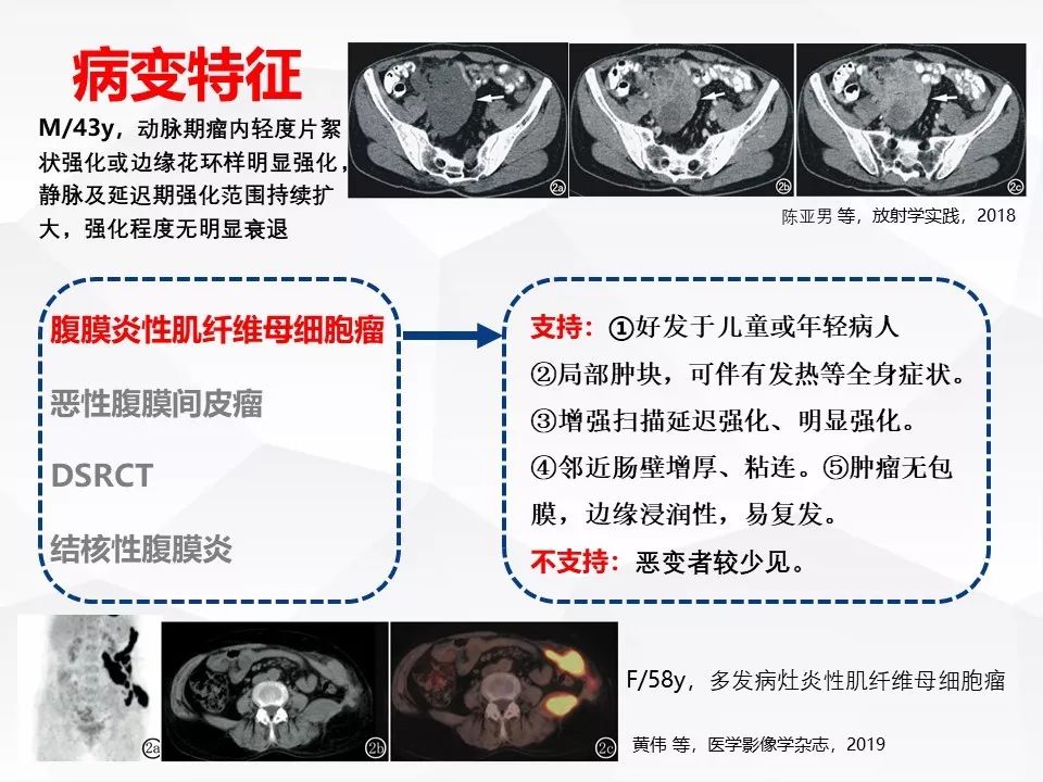 【病例】腹腔多发炎性肌纤维母细胞瘤IMT1例