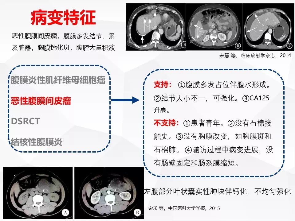 【病例】腹腔多发炎性肌纤维母细胞瘤IMT1例