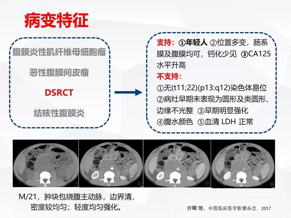 【病例】腹腔多发炎性肌纤维母细胞瘤IMT1例