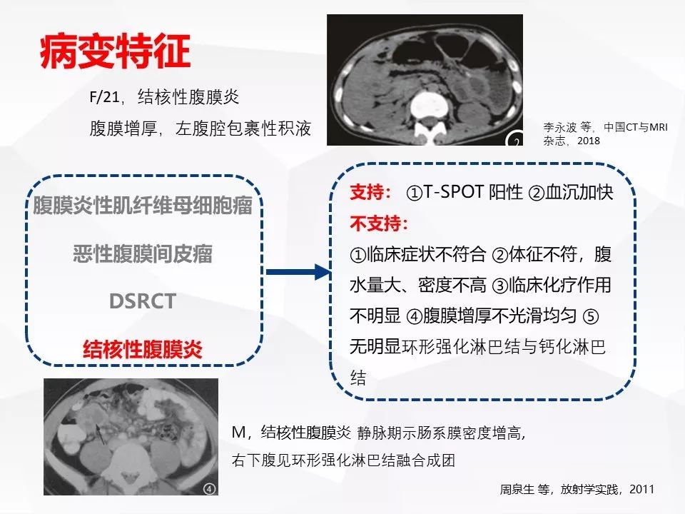 【病例】腹腔多发炎性肌纤维母细胞瘤IMT1例