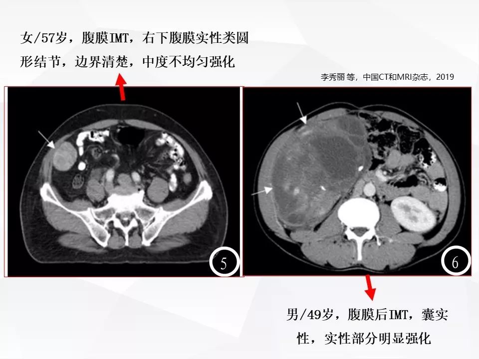 【病例】腹腔多发炎性肌纤维母细胞瘤IMT1例