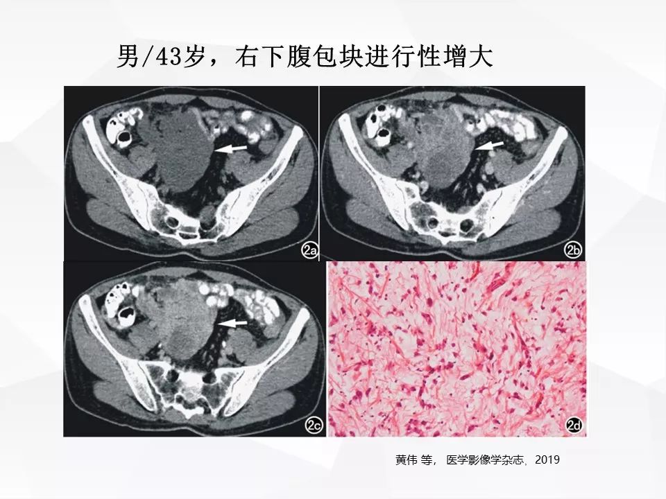 【病例】腹腔多发炎性肌纤维母细胞瘤IMT1例