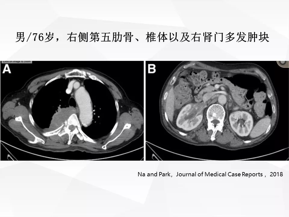 【病例】腹腔多发炎性肌纤维母细胞瘤IMT1例