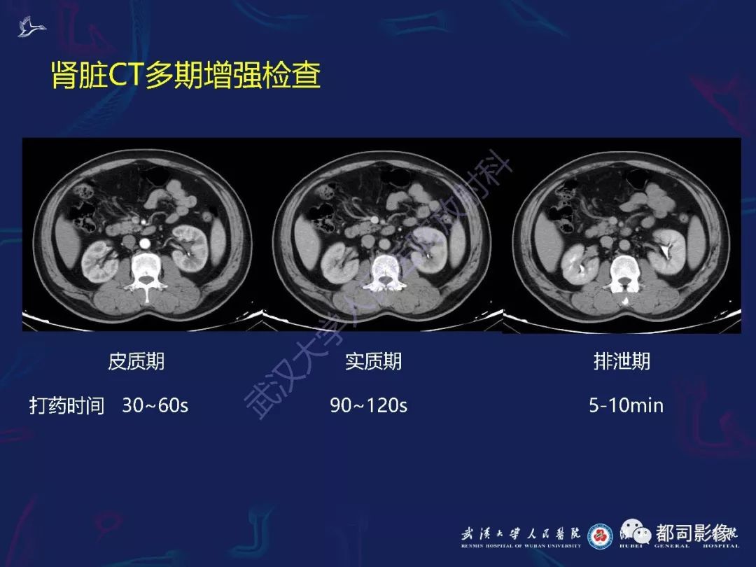 【PPT】常见肾脏肿瘤影像诊断