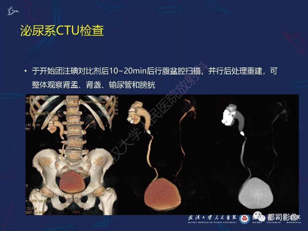 【PPT】常见肾脏肿瘤影像诊断
