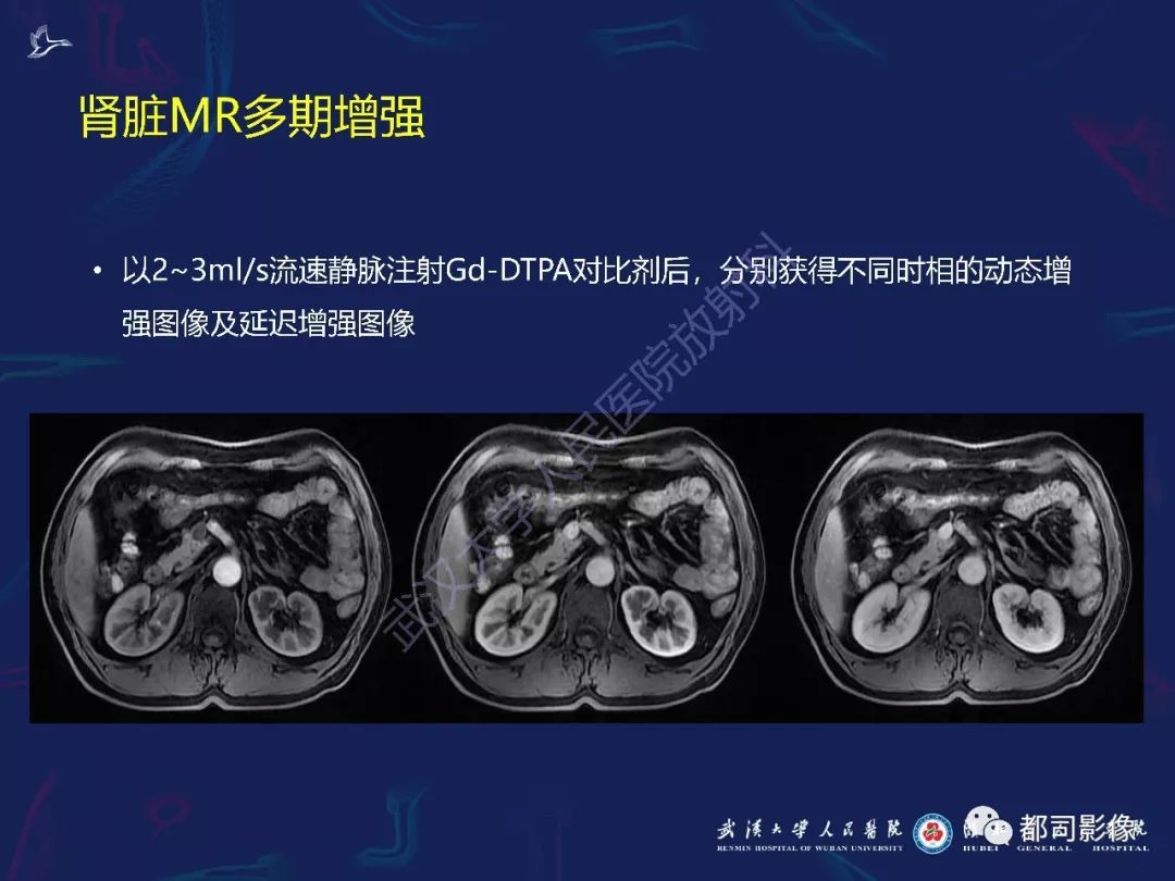 【PPT】常见肾脏肿瘤影像诊断
