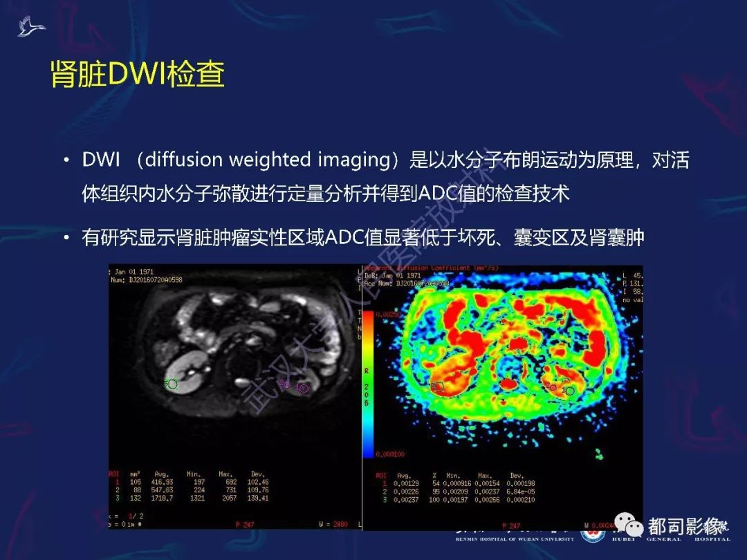 【PPT】常见肾脏肿瘤影像诊断