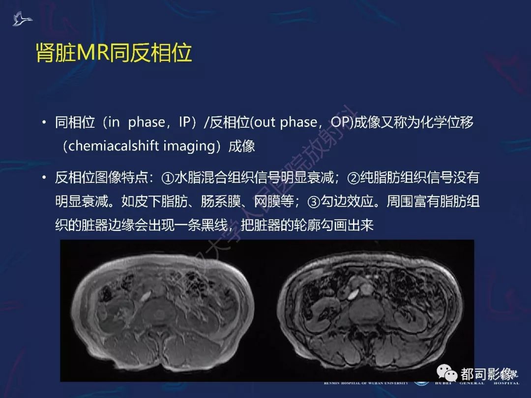 【PPT】常见肾脏肿瘤影像诊断