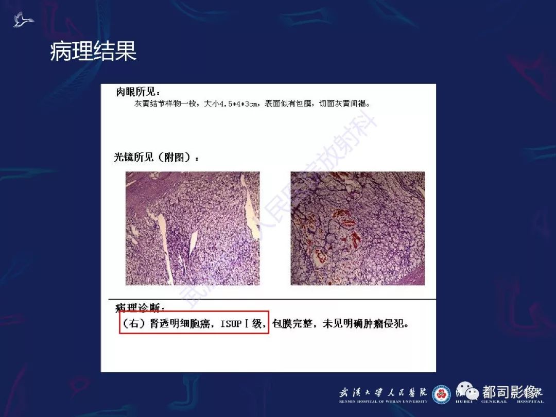 【PPT】常见肾脏肿瘤影像诊断