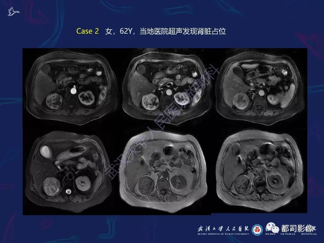 【PPT】常见肾脏肿瘤影像诊断