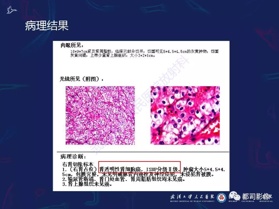 【PPT】常见肾脏肿瘤影像诊断