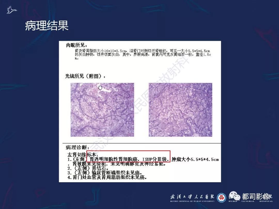 【PPT】常见肾脏肿瘤影像诊断