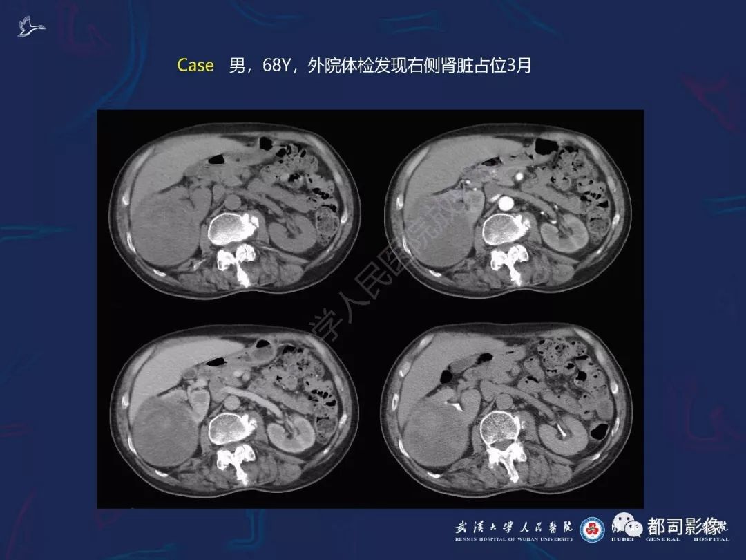 【PPT】常见肾脏肿瘤影像诊断