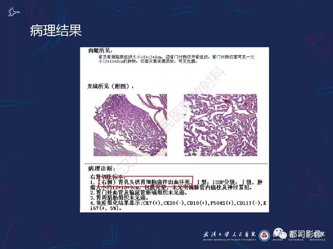 【PPT】常见肾脏肿瘤影像诊断
