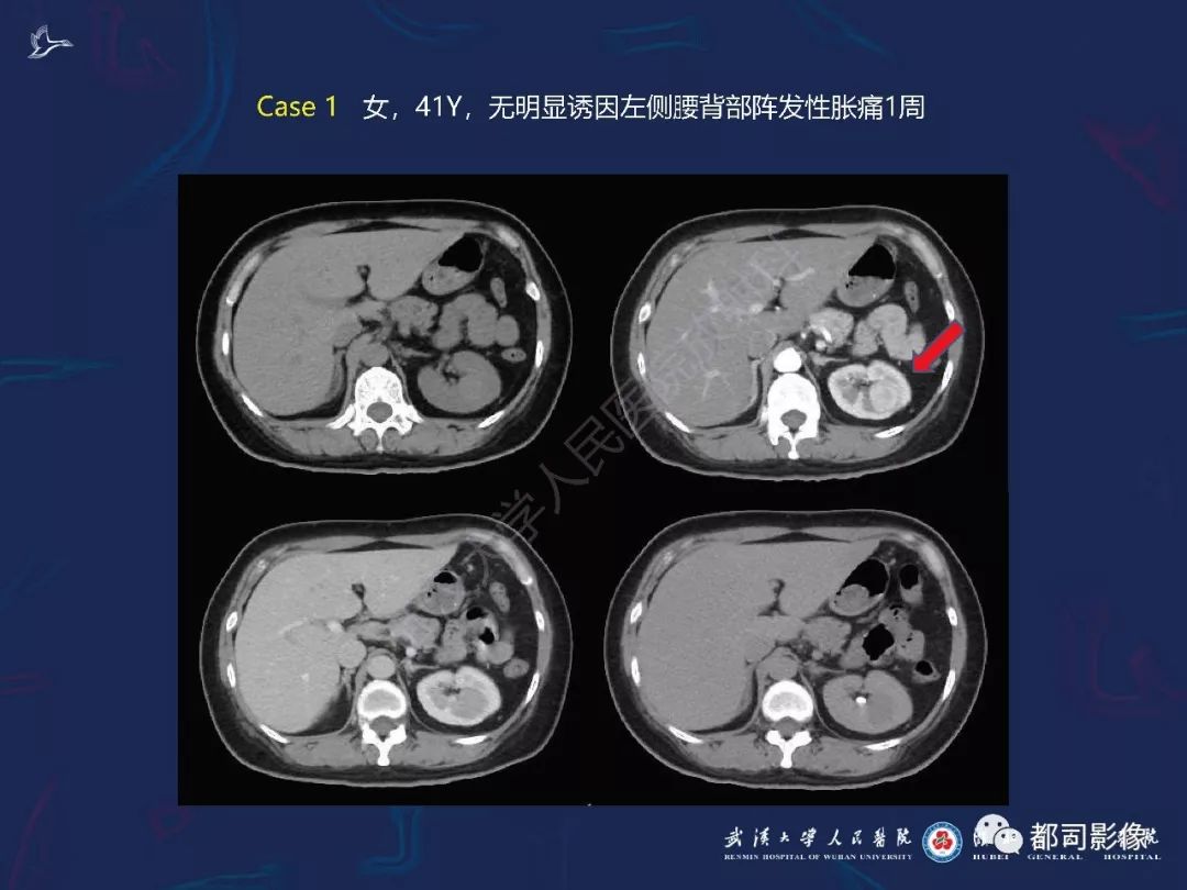 【PPT】常见肾脏肿瘤影像诊断