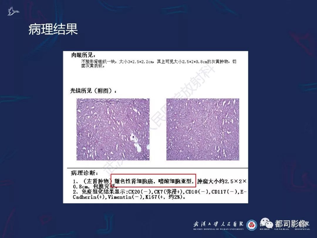【PPT】常见肾脏肿瘤影像诊断