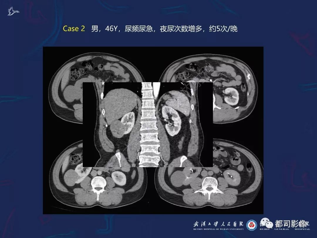 【PPT】常见肾脏肿瘤影像诊断