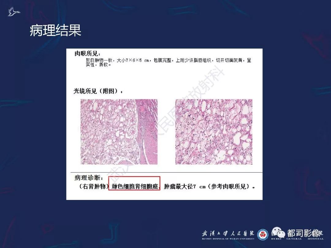 【PPT】常见肾脏肿瘤影像诊断
