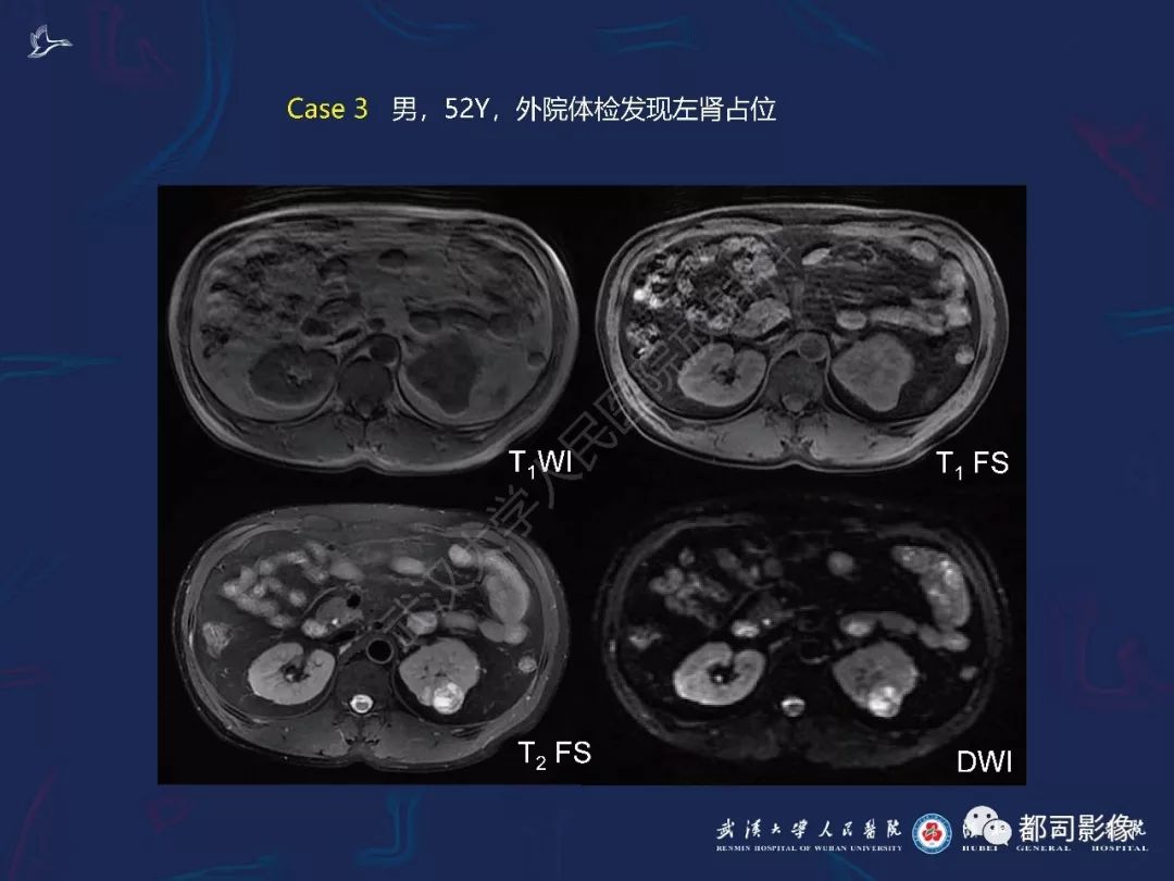 【PPT】常见肾脏肿瘤影像诊断