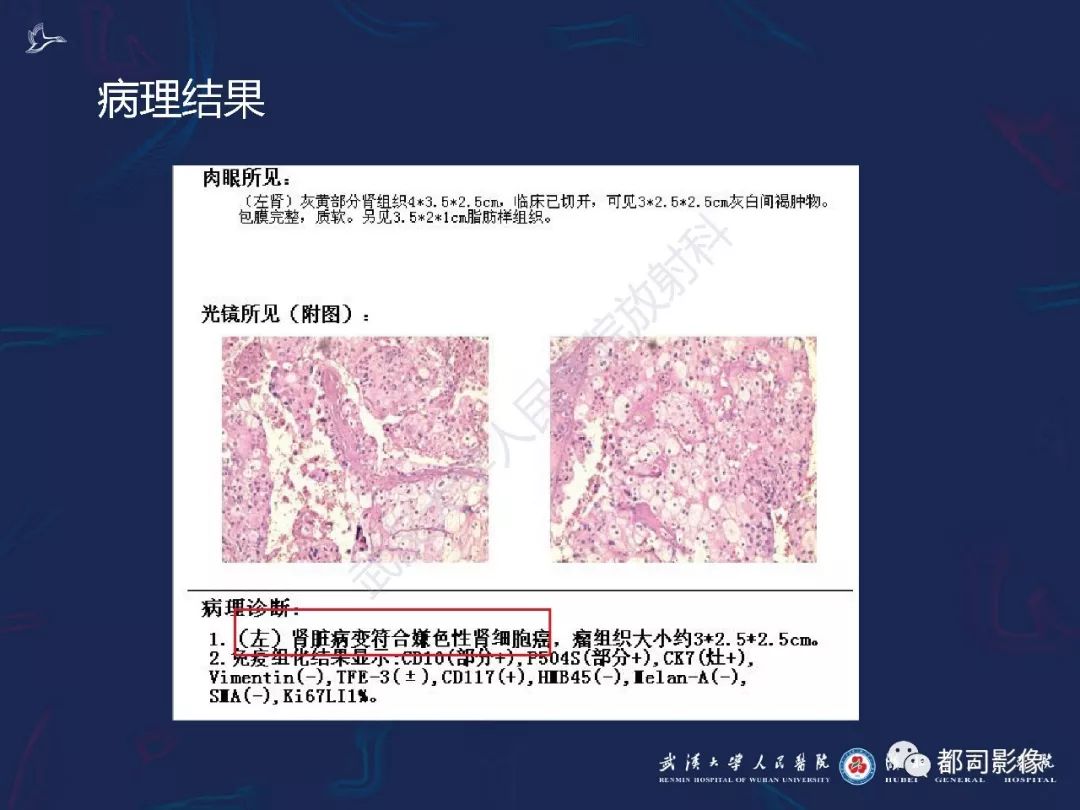 【PPT】常见肾脏肿瘤影像诊断