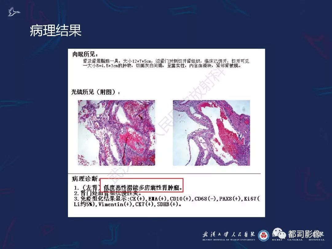 【PPT】常见肾脏肿瘤影像诊断