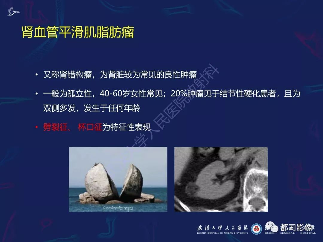 【PPT】常见肾脏肿瘤影像诊断