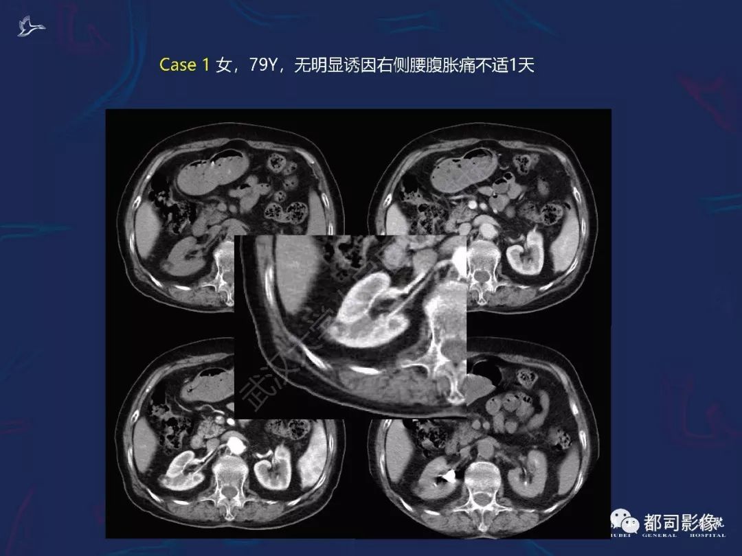 【PPT】常见肾脏肿瘤影像诊断