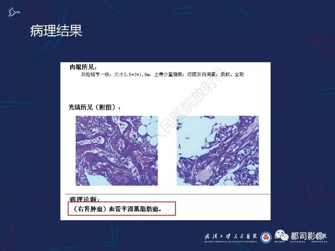 【PPT】常见肾脏肿瘤影像诊断