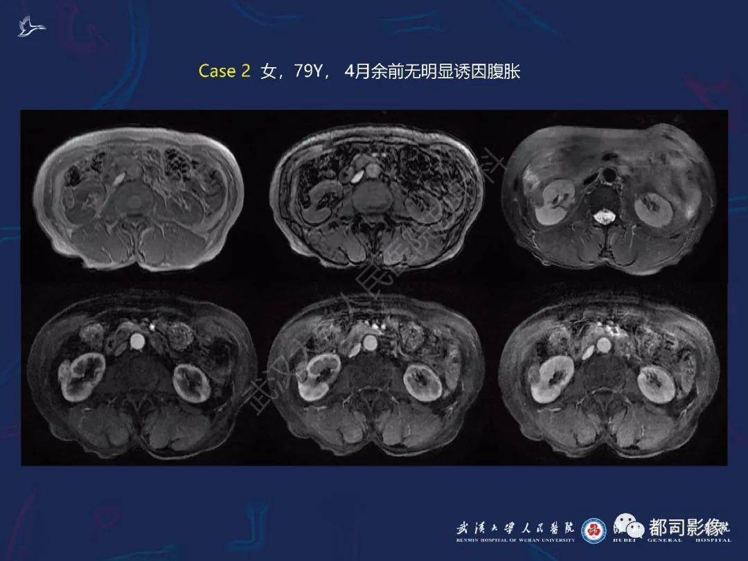 【PPT】常见肾脏肿瘤影像诊断