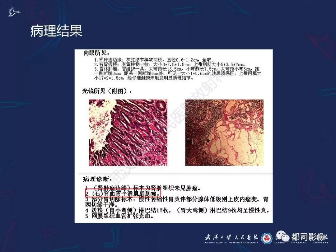 【PPT】常见肾脏肿瘤影像诊断