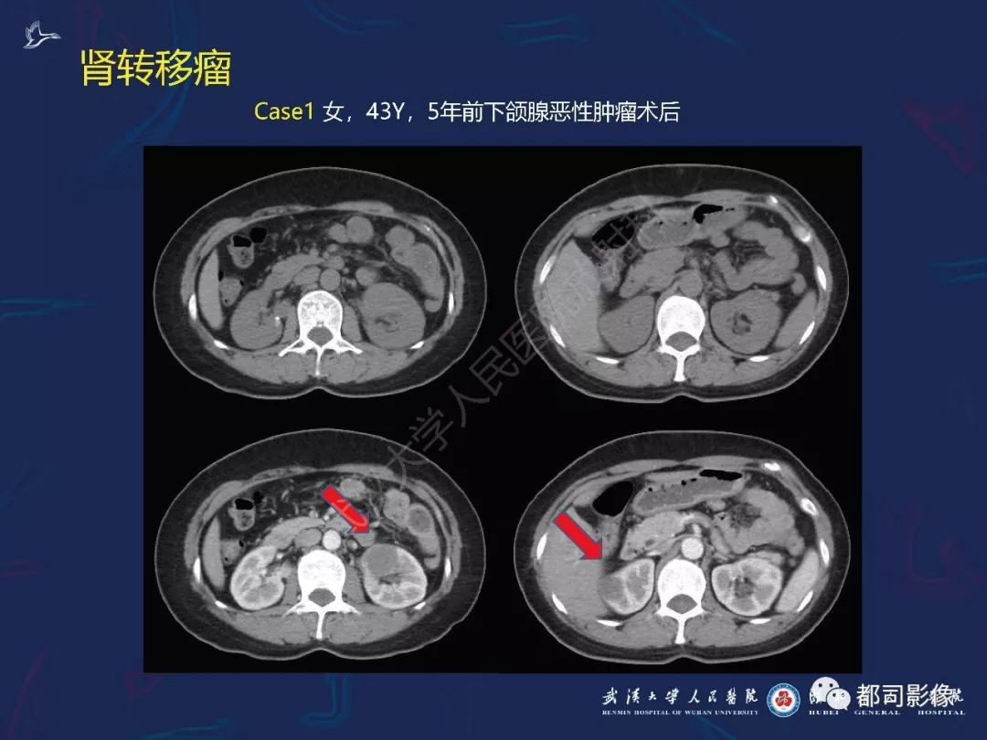 【PPT】常见肾脏肿瘤影像诊断