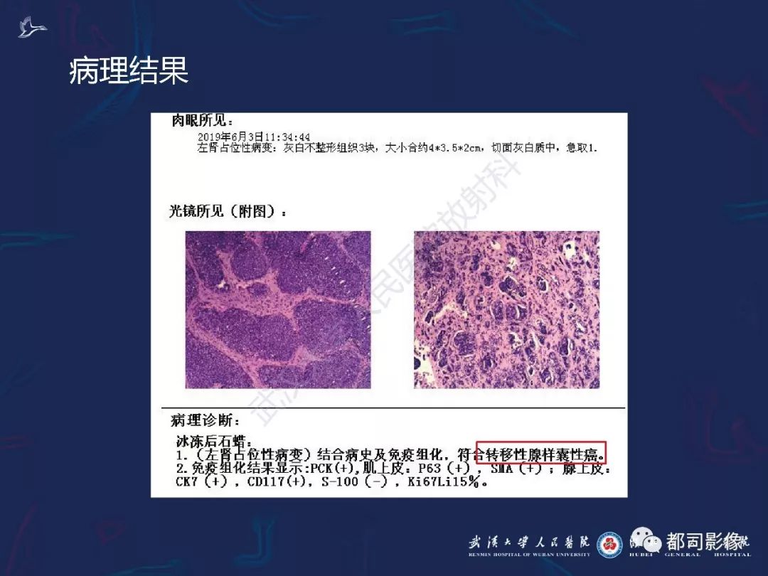 【PPT】常见肾脏肿瘤影像诊断