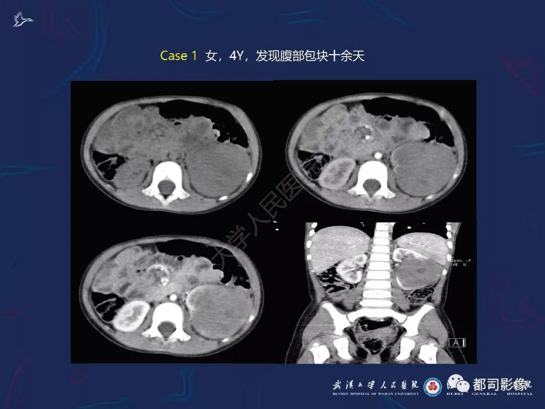 【PPT】常见肾脏肿瘤影像诊断
