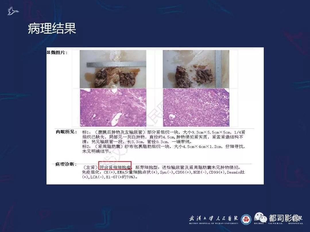 【PPT】常见肾脏肿瘤影像诊断