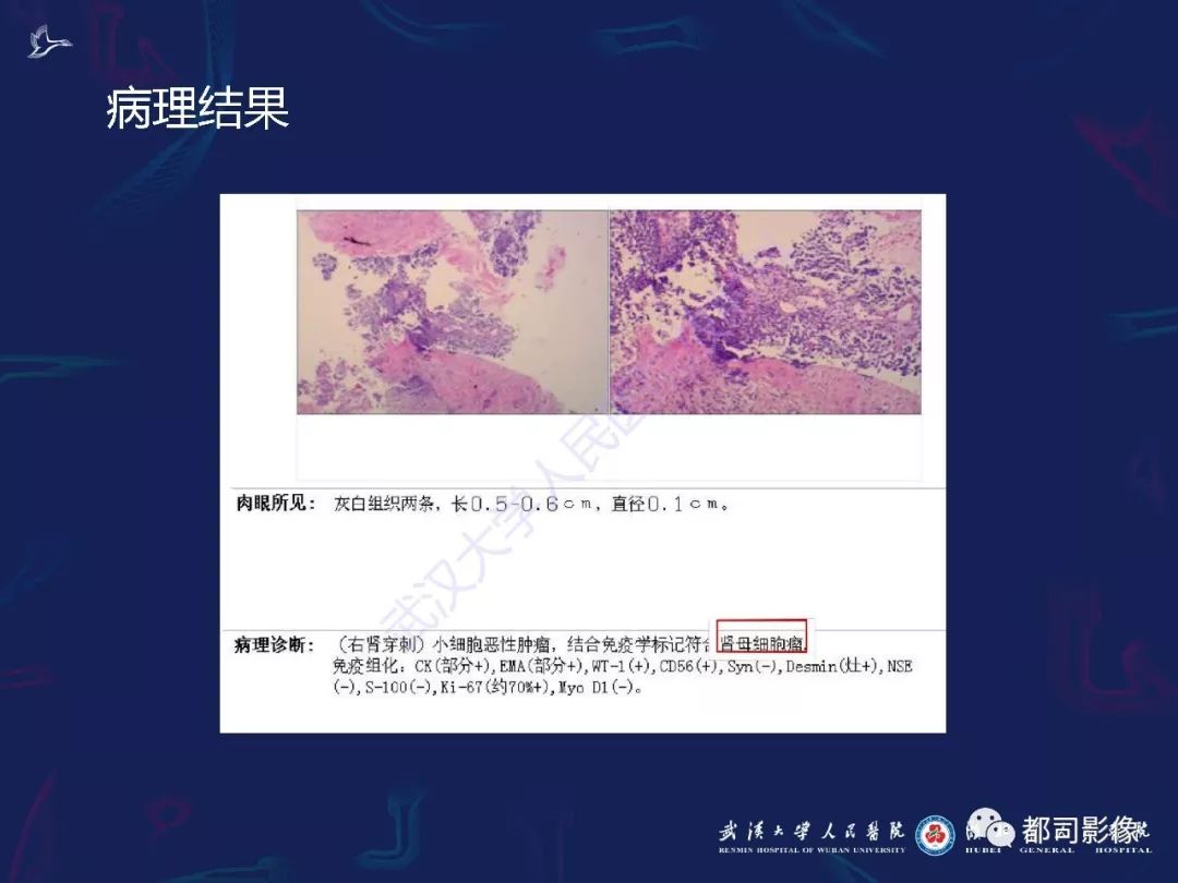 【PPT】常见肾脏肿瘤影像诊断