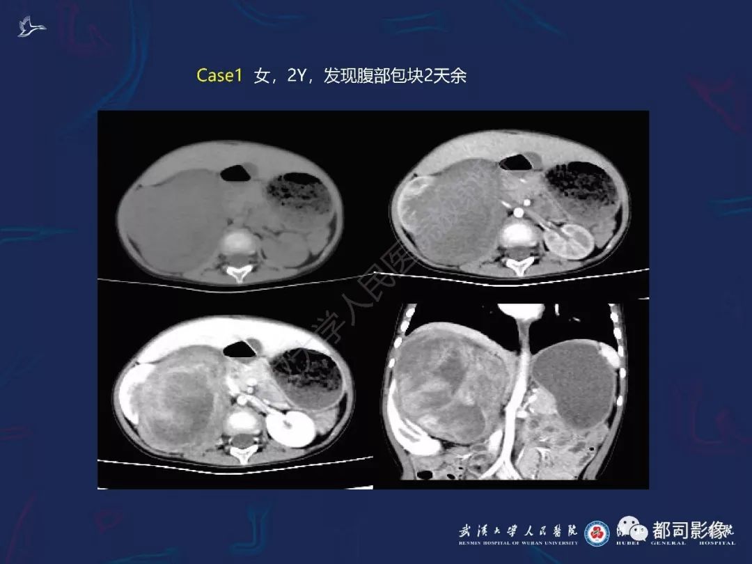 【PPT】常见肾脏肿瘤影像诊断
